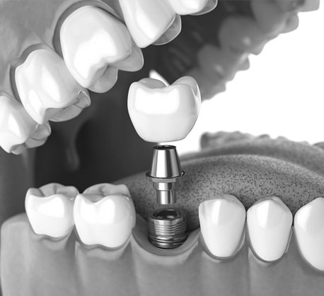 Dental Implants | Good Samaritan Medical & Dental | Sylvania, Sydney